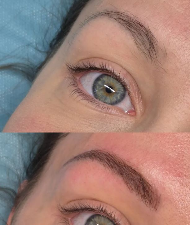 Brow lift résultat Marseille